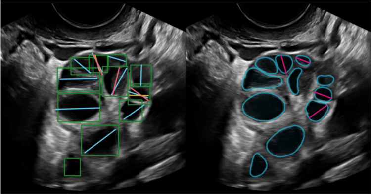 AI-Powered Follicle Measurement and Counting: Achieving Greater Efficiency and Consistency?